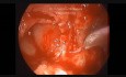Timpanomastoidectomia endoscópica 