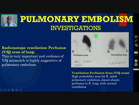 Tromboembolismo pulmonar