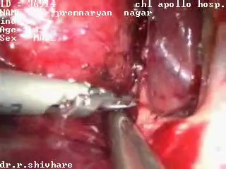 Adrenalectomía derecha laparoscópica - paciente masculino