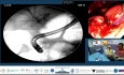 El cirujano dejó un drenaje. Nosotros dejamos un stent.