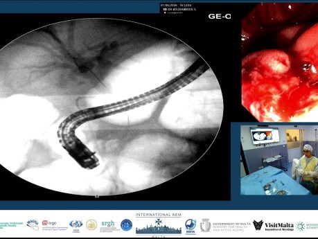 El cirujano dejó un drenaje. Nosotros dejamos un stent.