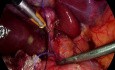 Colecistectomía laparoscópica para evitar las complicaciones del conducto biliar común