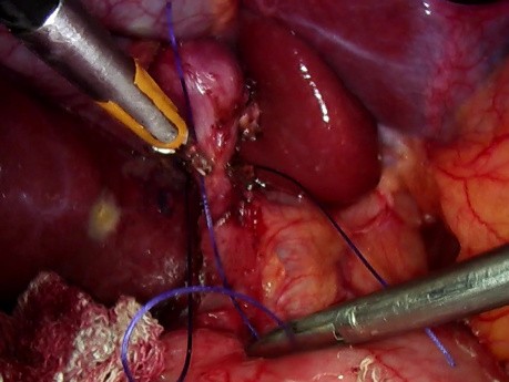 Colecistectomía laparoscópica para evitar las complicaciones del conducto biliar común