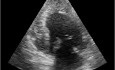Test de ecocardiografía. Vista apical. ¿Es normal el ventrículo izquierdo?