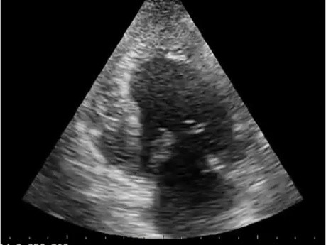 Test de ecocardiografía. Vista apical. ¿Es normal el ventrículo izquierdo?