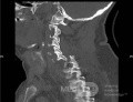 Abordaje Anterior de Cloward para Fractura Cervical AO Spine Tipo C con Síndrome de Brown Sequard