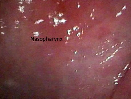 Endoscopia nasal flexible