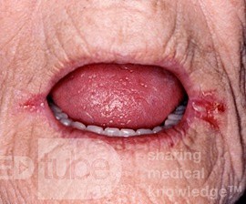Queilitis angular