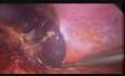 Esplenectomía laparoscópica para un quiste esplénico gigante