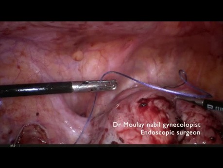 Miomectomía complicada con control de las arterias ilíacas internas
