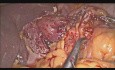 Perforación esofágica iatrogénica