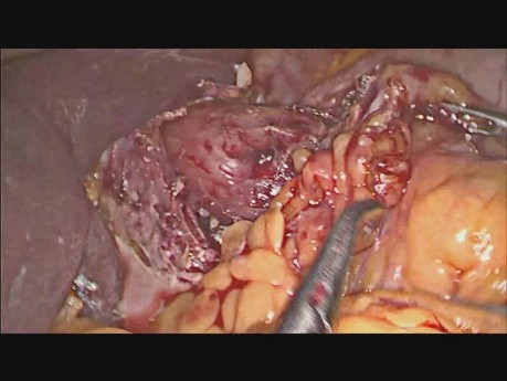 Perforación esofágica iatrogénica