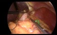 Fundoplicatura de Nissen laparoscópica con refuerzo hiatal