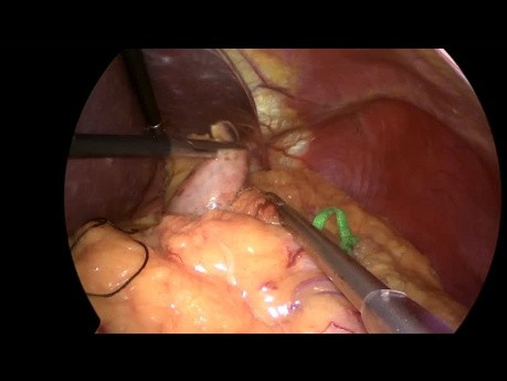 Fundoplicatura de Nissen laparoscópica con refuerzo hiatal