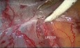 Linfadenectomía pélvica bilateral laparoscópica por carcinoma de endometrio