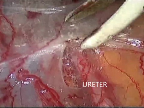 Linfadenectomía pélvica bilateral laparoscópica por carcinoma de endometrio