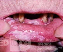 Hiperqueratosis del labio [leucoplasia]
