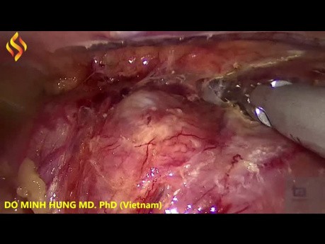 Esofagectomía toraco-laparoscópica - Parte torácica 1