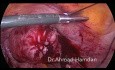 Miomectomía laparoscópica    