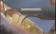 Limpieza dental - ultrasonidos