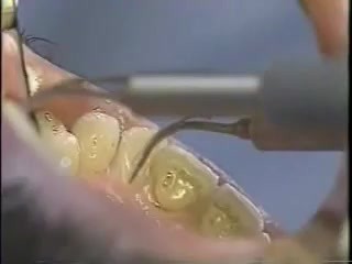 Limpieza dental - ultrasonidos