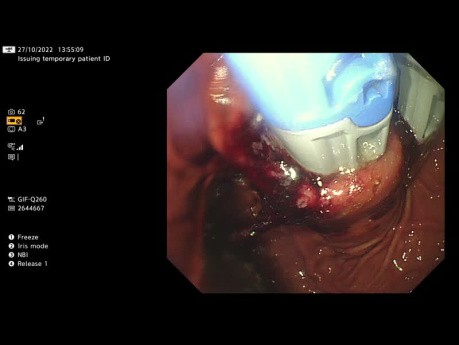 Funduplicatura transoral sin incisión (TIF)