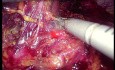 Metástasis suprarrenal izquierda ispsilateral tras nefrectomía. Extirpación laparoscópica.