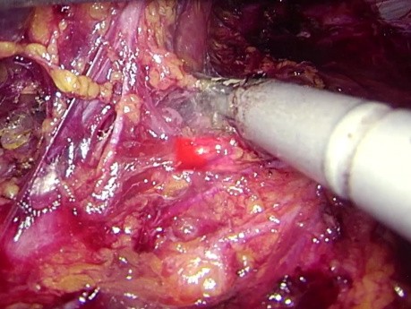 Metástasis suprarrenal izquierda ispsilateral tras nefrectomía. Extirpación laparoscópica.