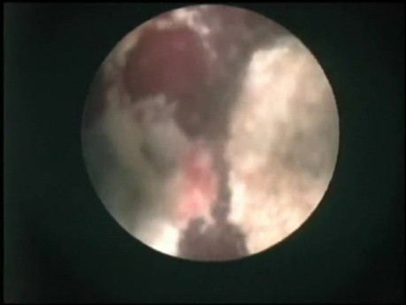 Nefrolitotomía percutánea - Cálculo infeccioso