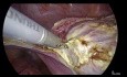 Histerectomía laparoscópica total: ¿importa el tamaño?