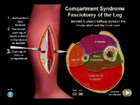 Síndrome compartimental abdominal