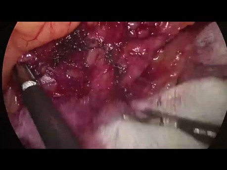 Sigmoidectomía laparoscópica. Movilización de flexión esplénica supracólica (video completo)