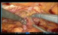 Caso de prostatectomía radical robótica con resultado temprano de trifecto