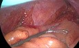 Escisión total del mesorrecto (TME) por laparoscopia para el cáncer de recto en un hombre con pelvis estrecha