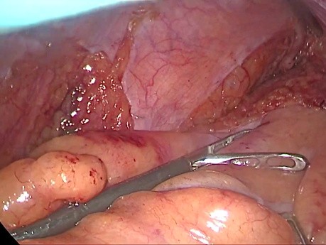 Escisión total del mesorrecto (TME) por laparoscopia para el cáncer de recto en un hombre con pelvis estrecha