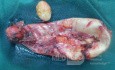Colecistitis aguda eliminada por colecistectomía laparoscópica