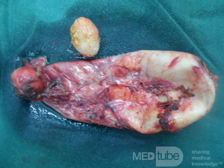 Colecistitis aguda eliminada por colecistectomía laparoscópica