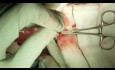 Técnica abierta de apendicectomía