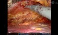 Abordaje robótico de hernia parainguinal izquierda