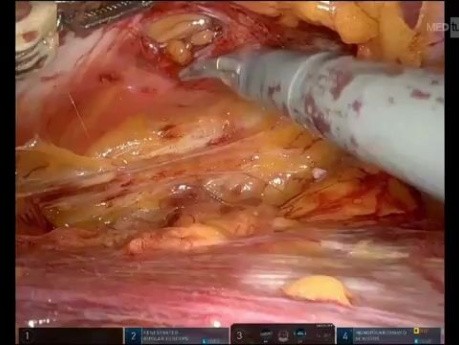 Abordaje robótico de hernia parainguinal izquierda