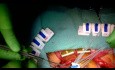 Cómo se implanta una válvula aórtica convencional (suturada) en la cirugía de sustitución de la válvula aórtica