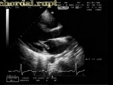 Rotura de cuerda tendinosa mitral 