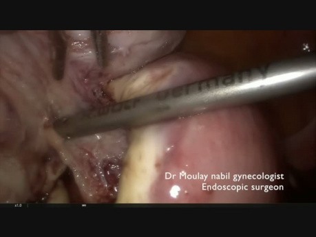 Miomectomía laparoscópica hemostática de emergencia