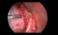 Cistadenoma gigante laparoscópico con torsión anexial
