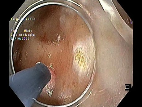 Coagulación con plasma de argón (APC) de ectasia vascular antral gástrica (GAVE) con Endocap