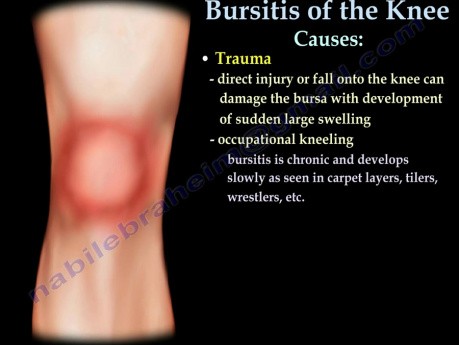 Causas de la bursitis de rodilla - video-clase