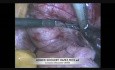 Resección laparoscópica de mioma de ligamento ancho