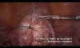 Polimiomectomía laparoscópica ambulatoria