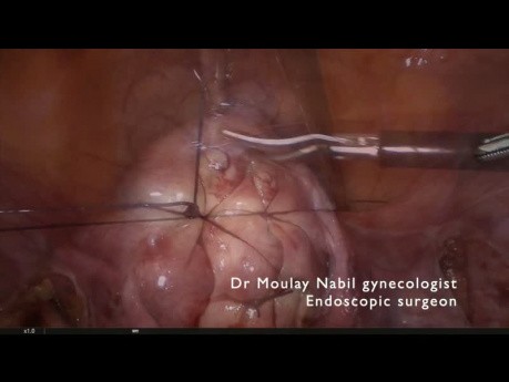 Polimiomectomía laparoscópica ambulatoria