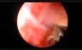Nefrolitotomía percutánea derecha
